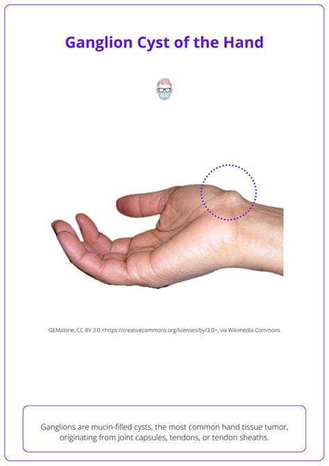 icd 10 code for right wrist ganglion cyst|M67.431 Ganglion, right wrist